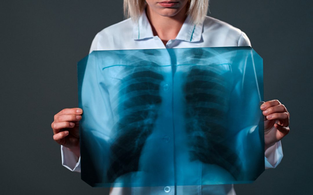 what-do-we-know-about-lung-cancer?