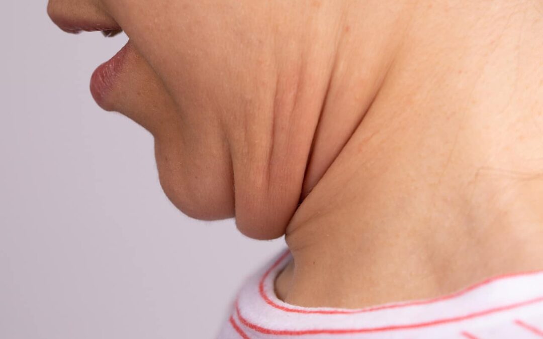 neck-fat:-causes,-implications-and-corrective-tips:-healthifyme